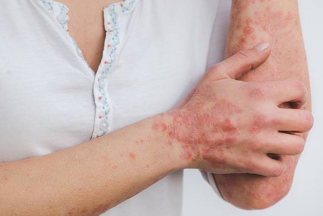 Les stratégies naturelles pour le traitement du psoriasis