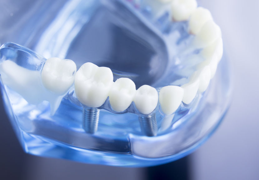 Comment se déroule la pose d'un implant dentaire ?